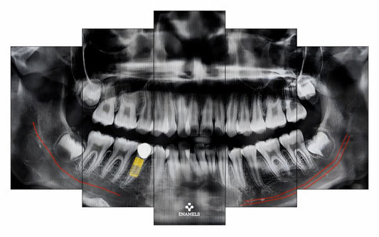 5 Pcs Split OPG - Implant Planning | Free Delivery|Medium enamels-online