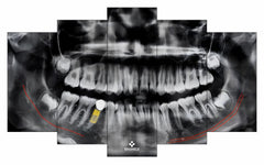 Large-5 Pcs Split OPG - Implant Planning | Large